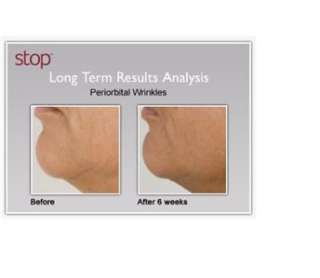 New Tripollar STOP   Anti Aging Face Skin Care Renewal  