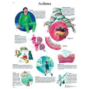  Asthma Laminated Poster