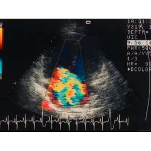  Doppler Echocardiogram. Ultrasound Tricuspid Regur 