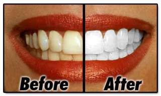 NEW 2 x CREST INTENSIVE PROFESSIONAL PRO EFFECTS 2 HOUR WHITESTRIPS 